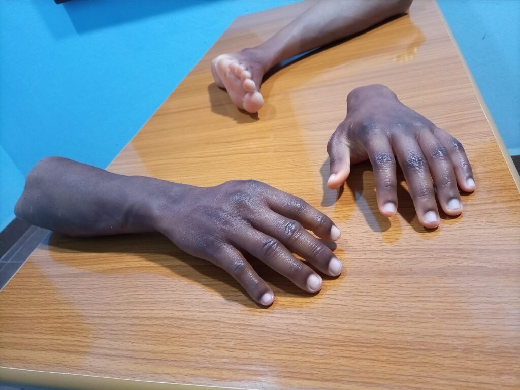 Prothèse de main John Amanam 